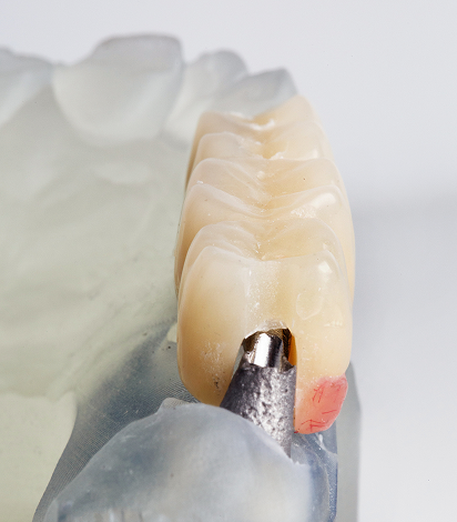 Fixed Teeth & Bridges
