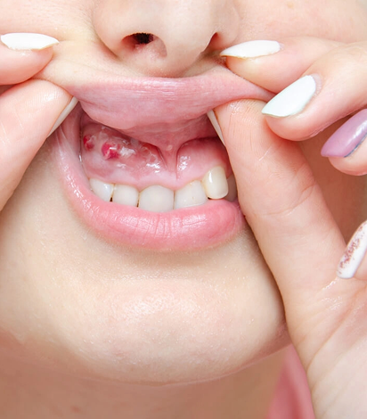 Laser Gum Treatment