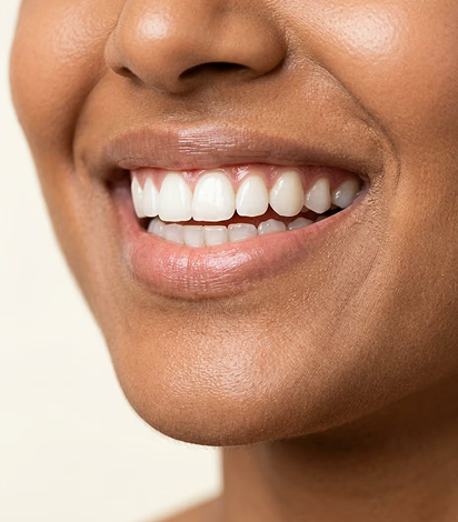 Smile Makeover