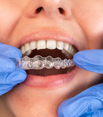 Aligners & Braces