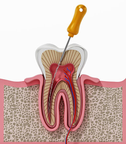 Root Canal Treatment