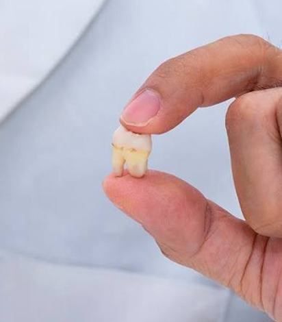 Wisdom Tooth Removal